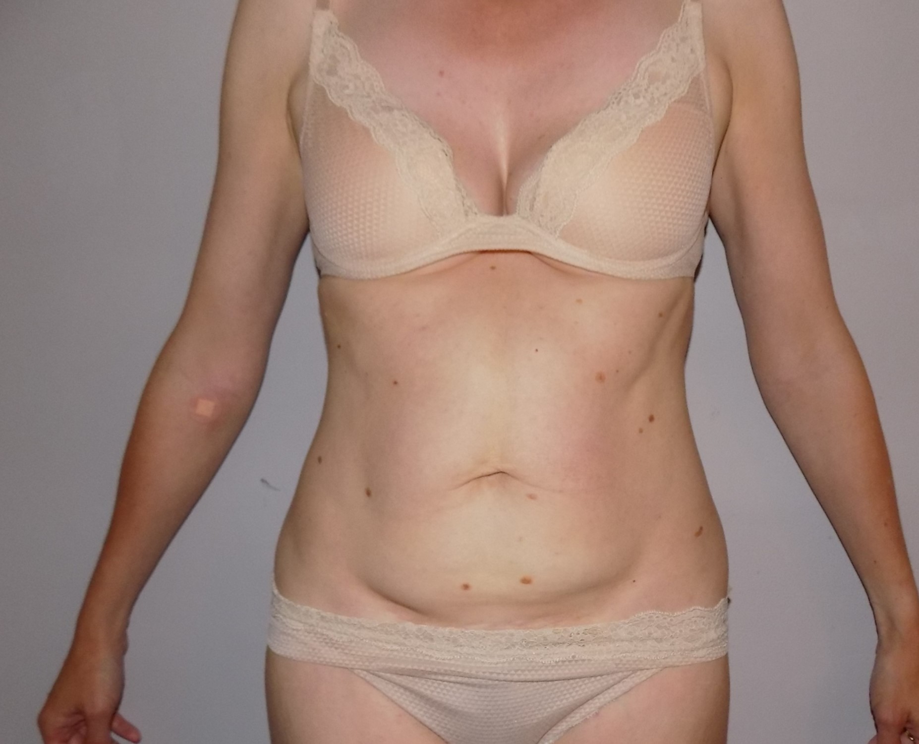 Before and after Fat Freezing Result
