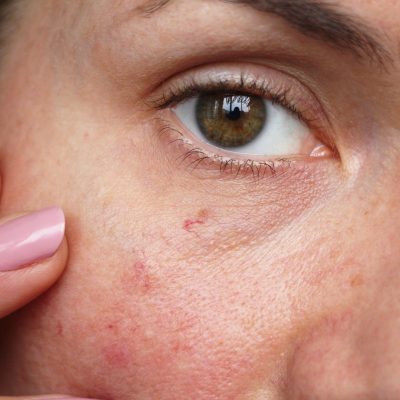 rosacea skin condition - marlow cosemetic skin treatments