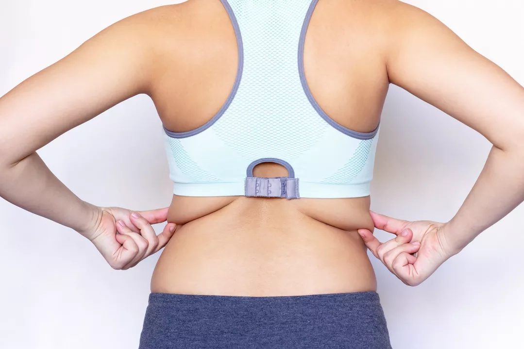 Bra Line Fat Removal