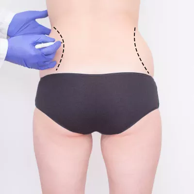Love Handle Fat Removal Buckinghamshire Skin Clinic