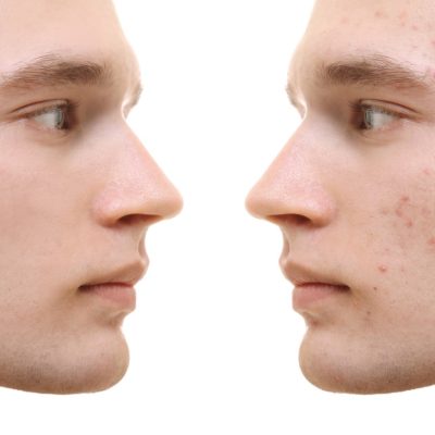 Image of acne condition. Skin Cosmetics in Marlow