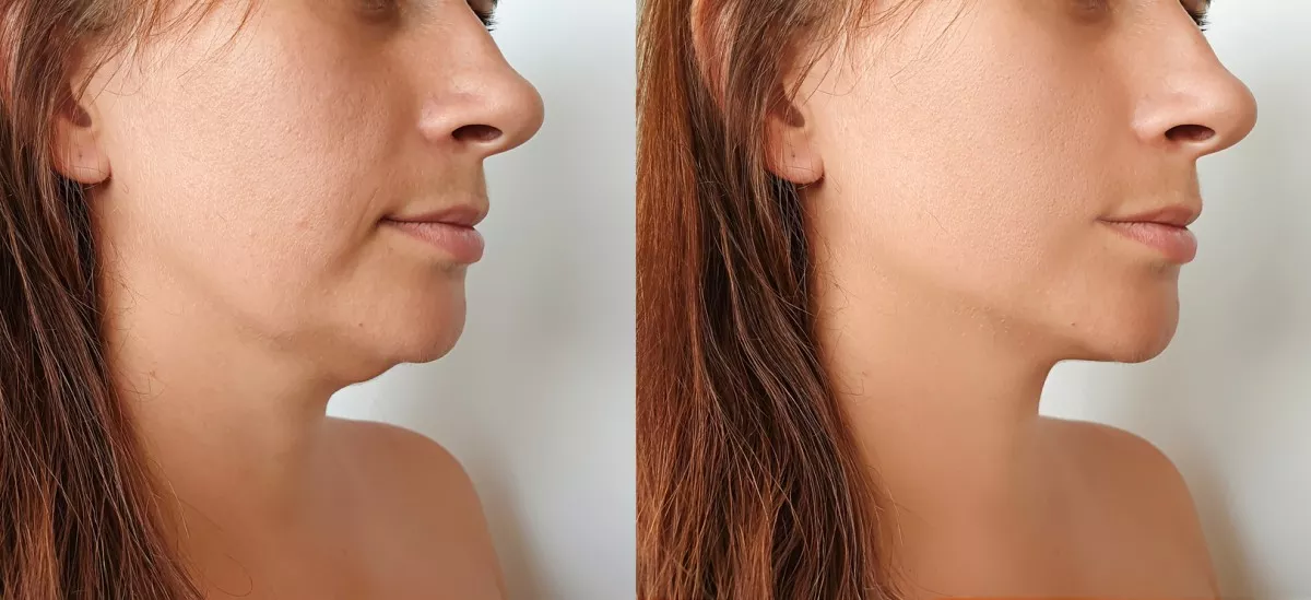 Chin Fat Removal